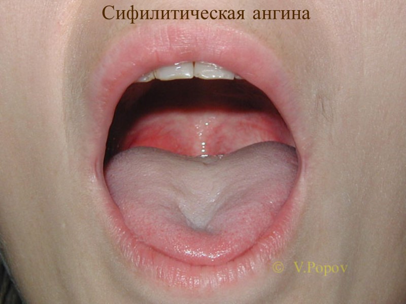 Сифилитическая ангина